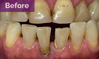 Before - Dental Crowns On Lower Front Teeth
