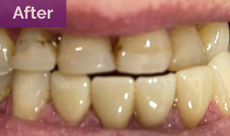 After - Dental Crowns On Lower Front Teeth