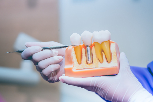 Dentist,With,Tooth,Implant,False,Teeth.,Dentistry,And,Healthcare,Concept